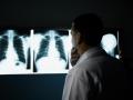 Neumotórax espontáneo. Se caracteriza por la presencia de aire en la pleura. En los casos de pacientes de covid, se han dado casos en el 1 % de los contagios, aunque se desconocen los motivos.