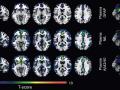 Un estudio identifica dos biomarcadores en sangre para captar los primeros indicios del Alzheimer