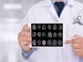 El Alzheimer se debe a la disminución de las proteínas y no por acumular placas amiloides, según un nuevo estudio