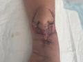 El implante sobre el brazo de la paciente