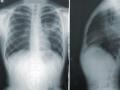 Radiografía de pulmón de una persona con coronavirus