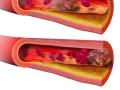 La trombosis es una afección que ocurre cuando se forma un coágulo de sangre en una vena profunda