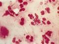 Gonorrea