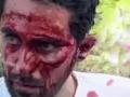 Alberto Contador, con la cara llena de sangre tras su caída