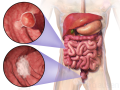 El cancer de colon se origina por pólipos que terminan derivando en tumor