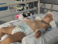 La pequeña de un año estuvo hospitalizada con una hemorragia craneal