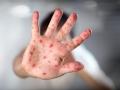 La viruela del mono es la nueva preocupación sanitaria a nivel mundial