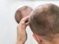 Hombre con calvicie mirándose al espejo