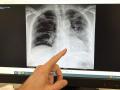 Radiografía de un paciente fumador en la que se señala la base del pulmón izquierdo, afectado de cáncer de pulmón