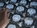 El CSIC consigue diseñar una molécula a través de IA, para tratar el alzhéimer y el cáncer