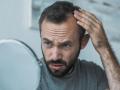 upset middle aged man with alopecia looking at mirror, hair loss concept