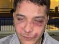 Pablo presenta hematomas y contusiones en su rostro tras la agresión