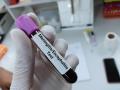 bioquímico sostiene una muestra de sangre para la prueba de PCR de meningitis o encefalitis