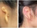 La oreja, antes y después del implante