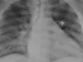 Radiografía neumonía por covid