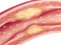 Adherencias en las arterias provocadas por el colesterol