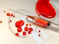 Primer ensayo clínico en curso de glóbulos rojos cultivados en laboratorio