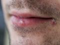 Herpes labial