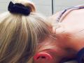 La acupuntura es eficaz para el dolor de cuello
