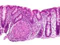 Enfermedad de Crohn