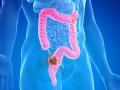 Recreación de un cáncer colorrectal