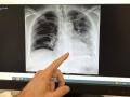 Radiografía de un paciente fumador en la que se señala la base del pulmón izquierdo, afectado de cáncer de pulmón