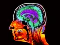 Una resonancia magnética cerebral (imagen coloreada artificialmente) puede detallar el riesgo de pérdida de memoria y otras dificultades cognitivas