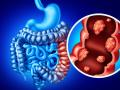 Cáncer de colon