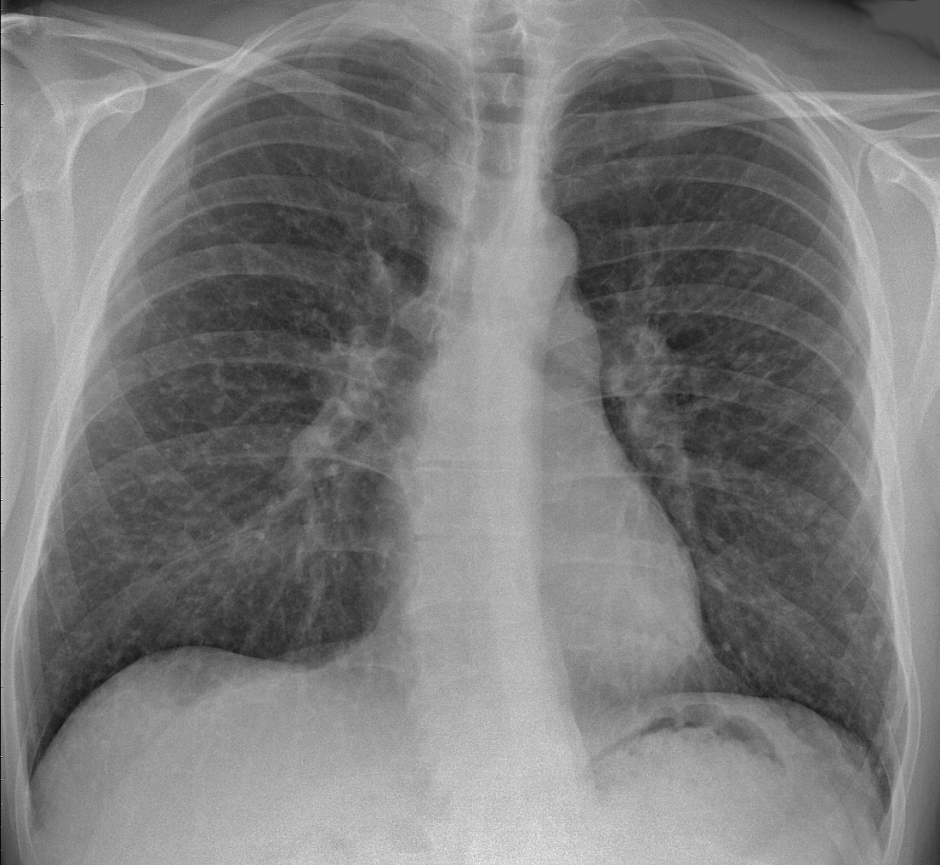 Radiografía torácica de un paciente con sarcoidosis