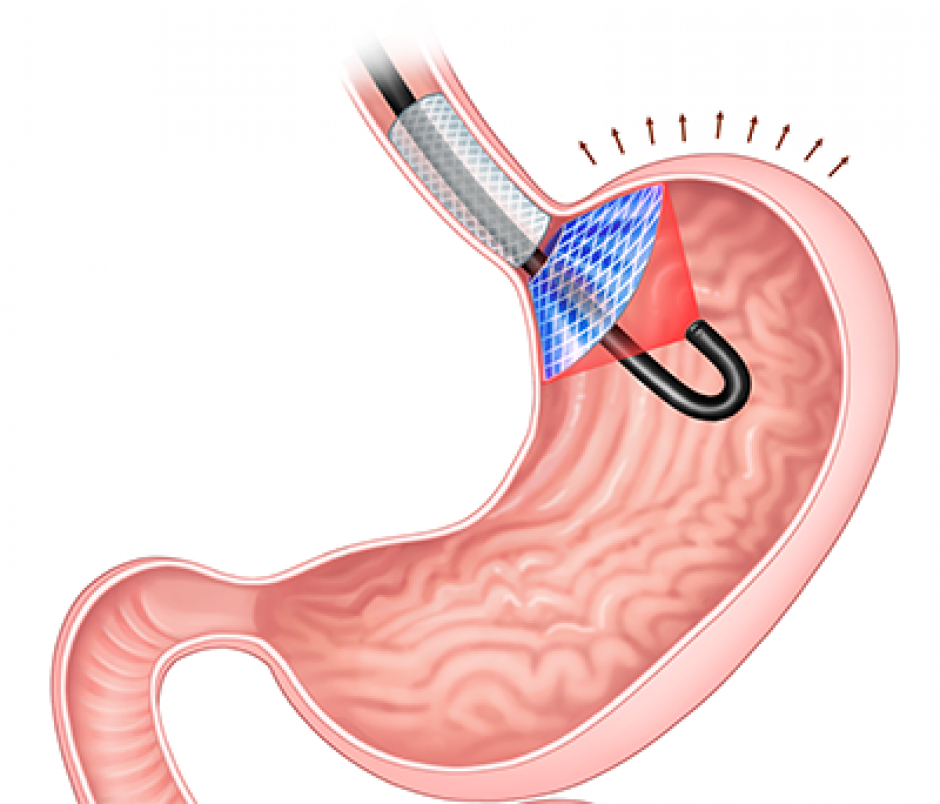 Un implante (azul y gris) crea una sensación de saciedad al presionar el estómago