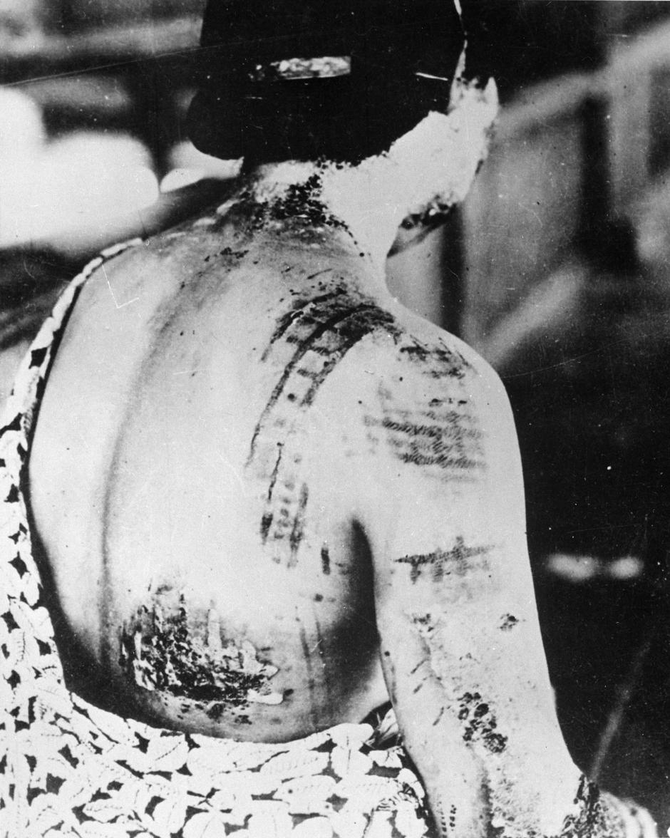 El patrón de la ropa usada por un sobreviviente se quemó en su piel en áreas ajustadas