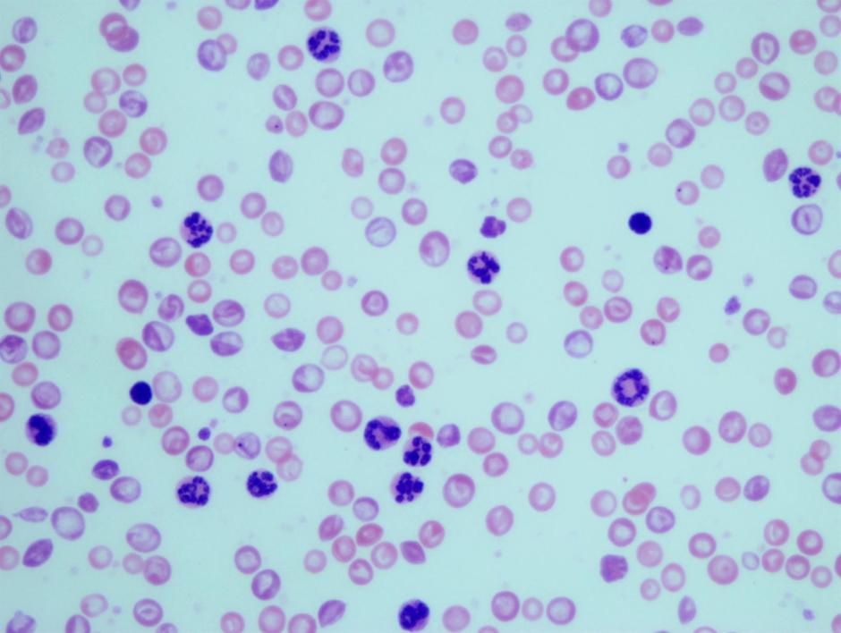 Granulocitos en muestras sanguíneas de ratones con leucemia mielogénica crónica