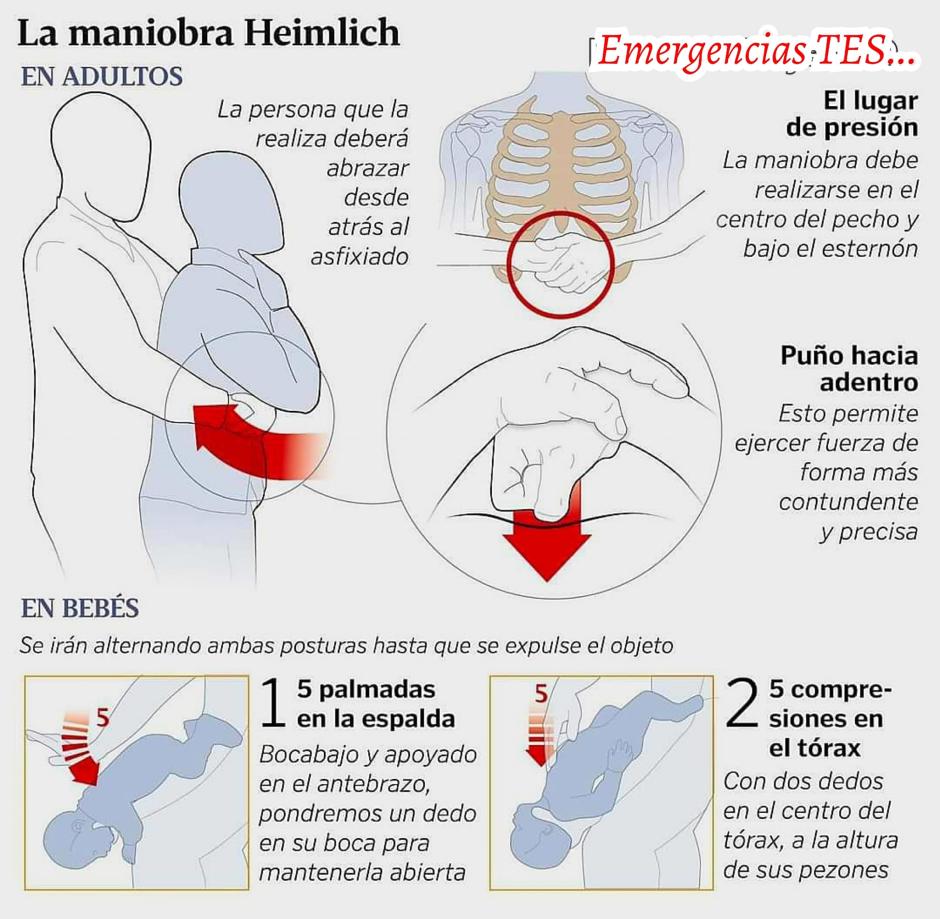 Maniobra de Heimlich