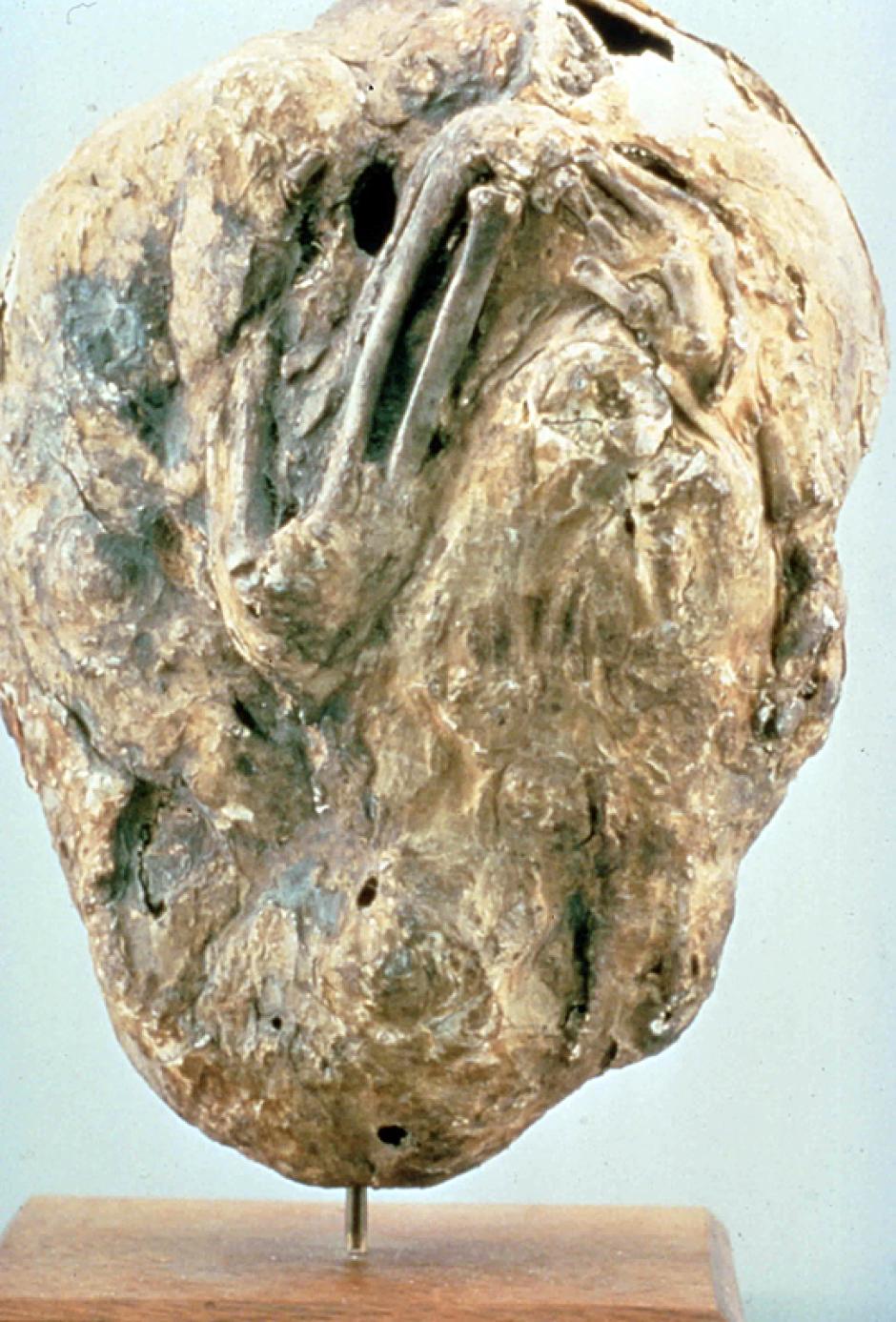 feto muerto y calcificado pasó en torno a 50 años en el vientre de su madre