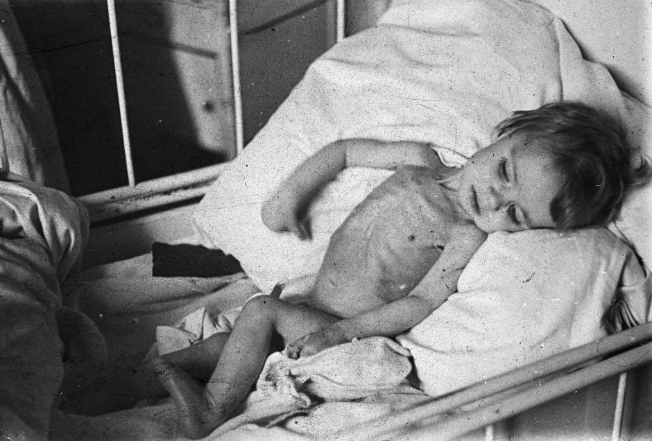 Niño holandés desnutrido en La Haya