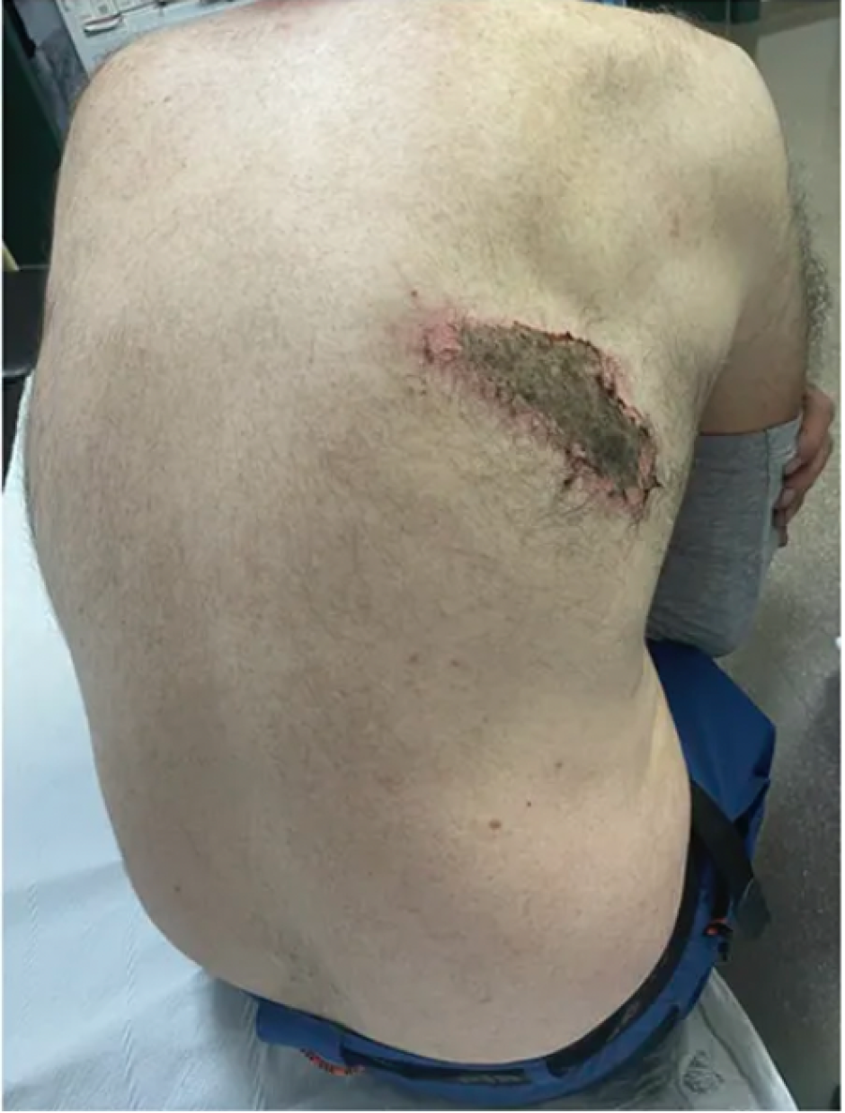 Imagen de la picadura de la avispa velutina pasadas 6 horas