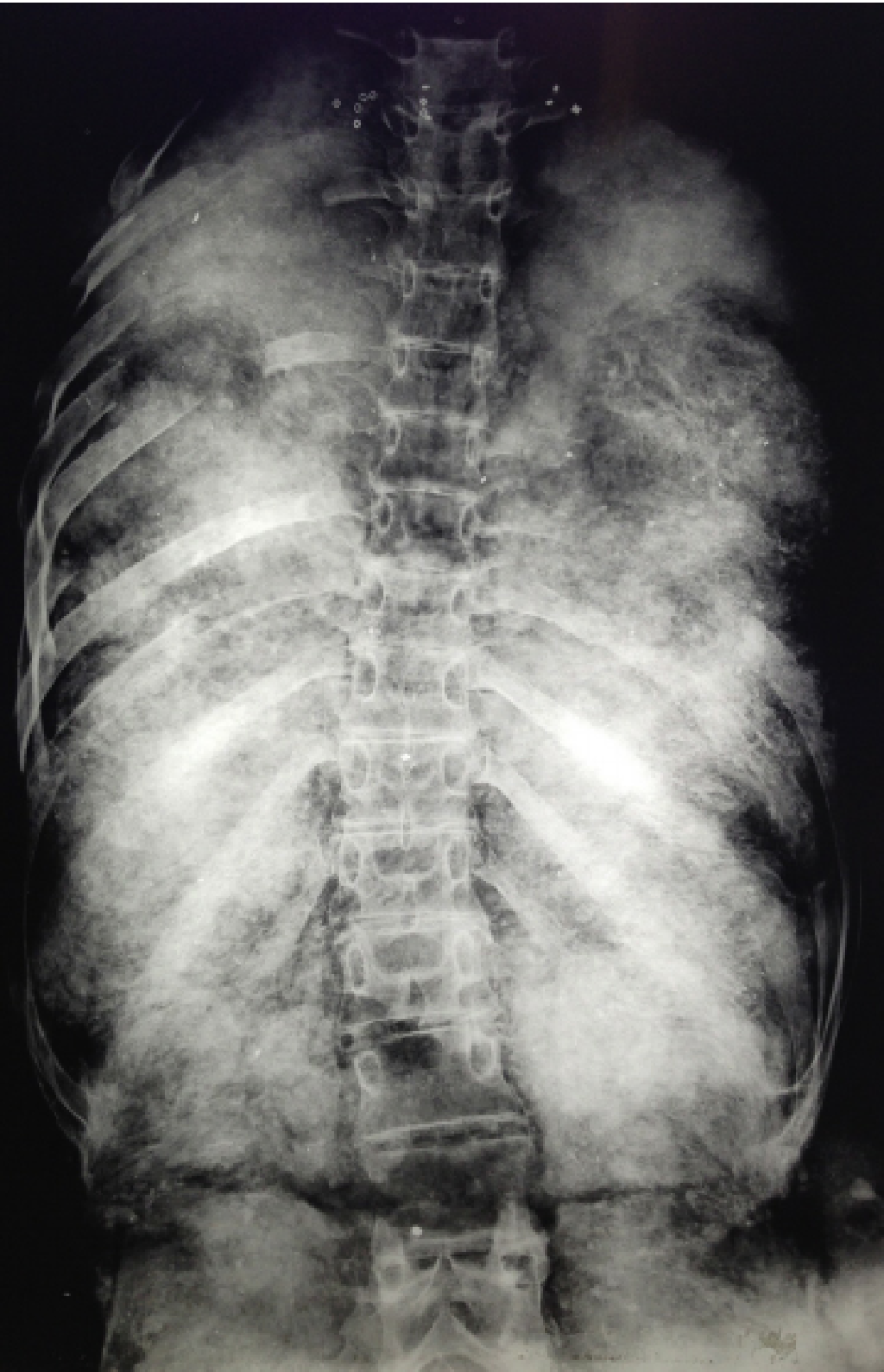 Radiografía del torso de Tutankamón que muestra el estado de las costillas, así como el relleno de la zona abdominal.