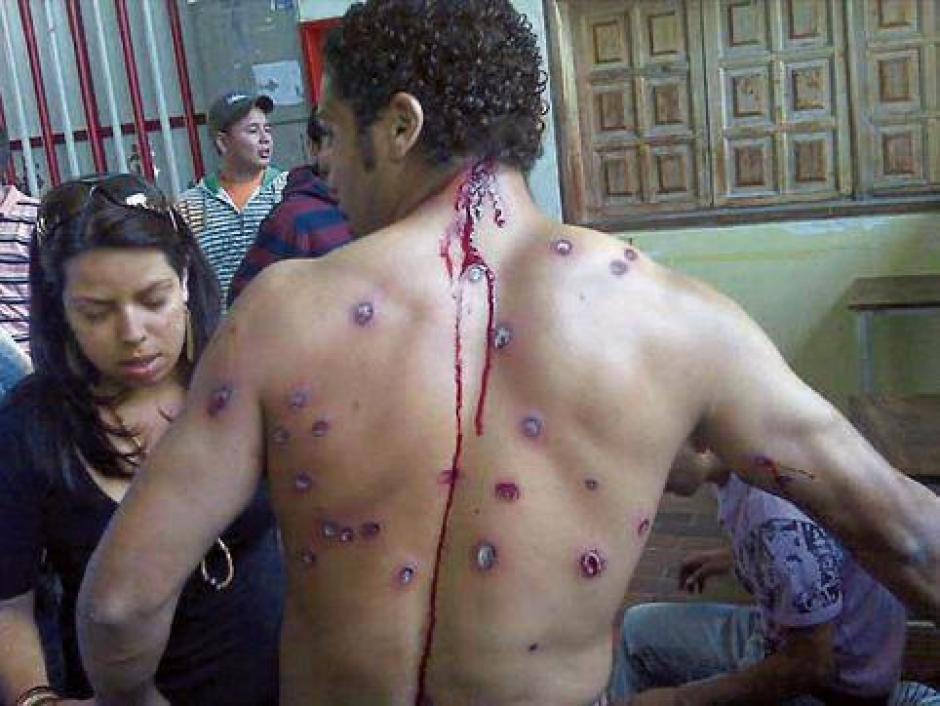 Villca Fernández, muestra sus lesiones tras una violenta represión de la Guardia Bolivariana (Archivo)