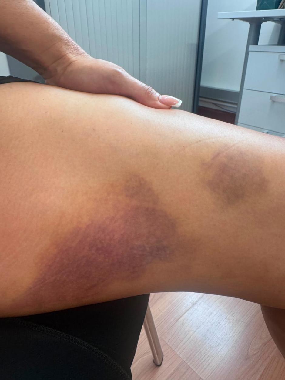 Moratones en el pierna de Alicia Tomás tras la agresión
